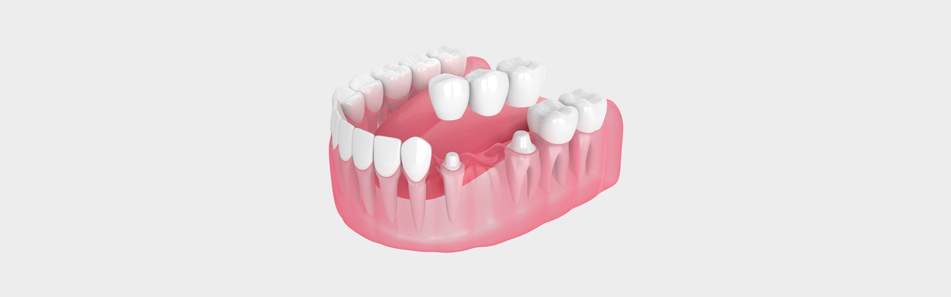Dental Bridges