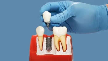 Benefits of Dental Implants for Oral Health and Jawbone Preservation