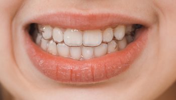How Bite Alignment Affects Long-Term Oral Health — And Why Dental Implants Require a Whole-System Approach